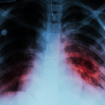 Advancing Digital Innovation in TB Care