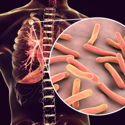 Targeting TB Transmission Through Innovation